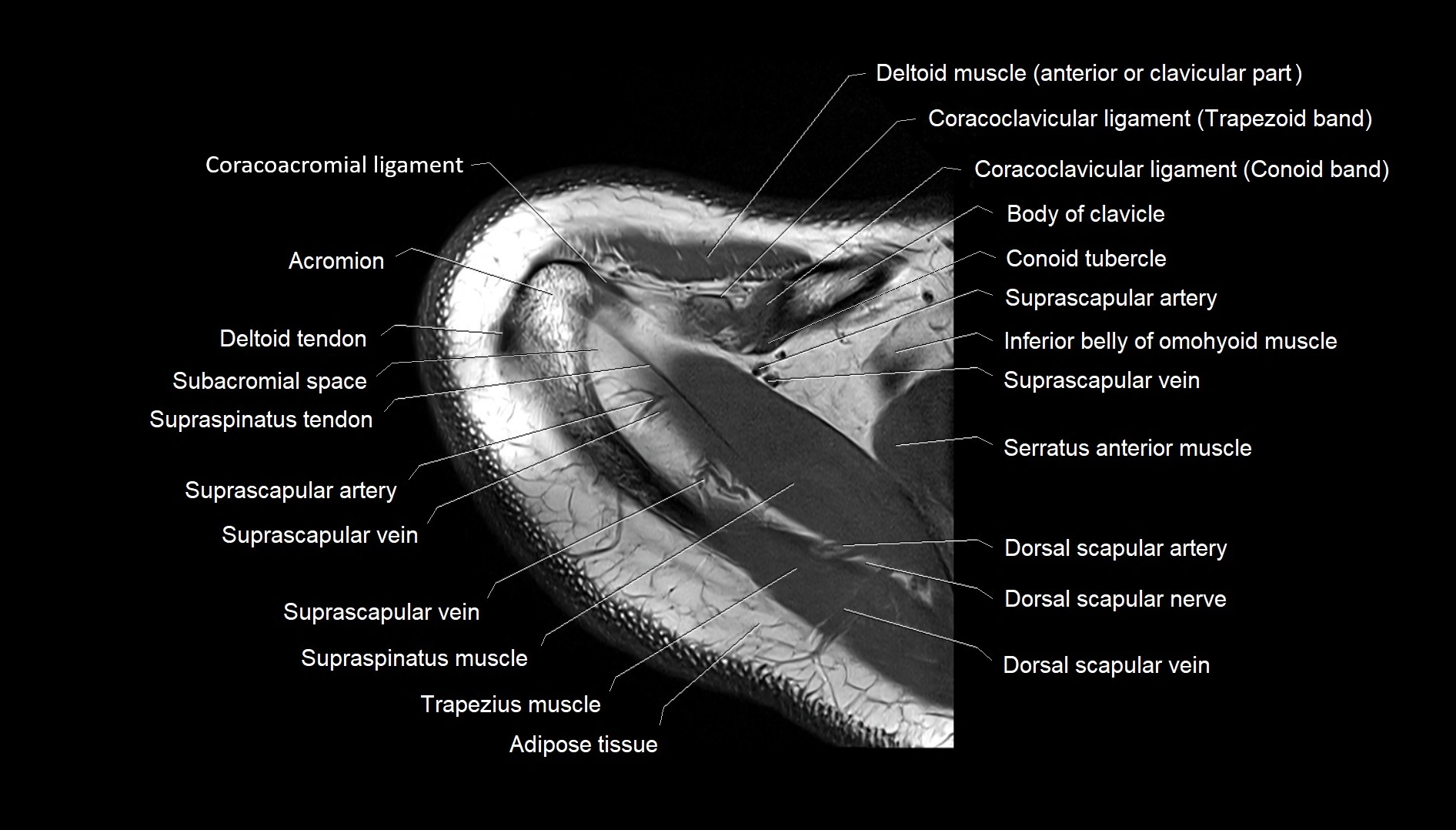 Shoulder cross sectional anatomy MRI 3T axial image 8.webp